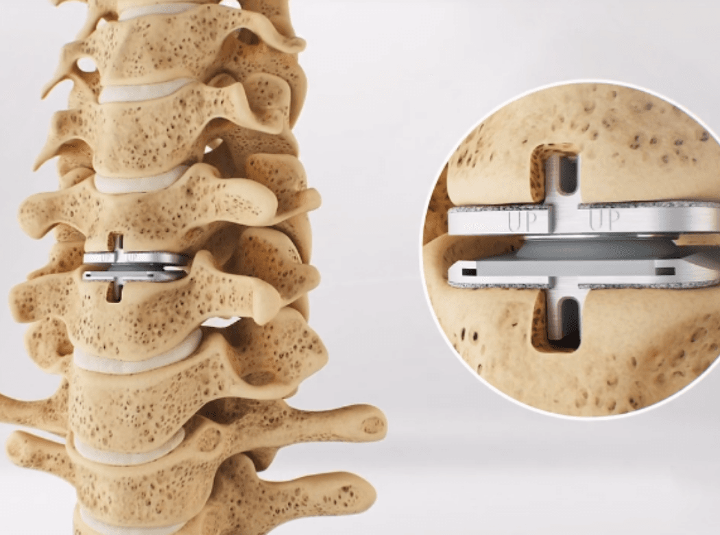 Surgical team performing an artificial disc replacement procedure