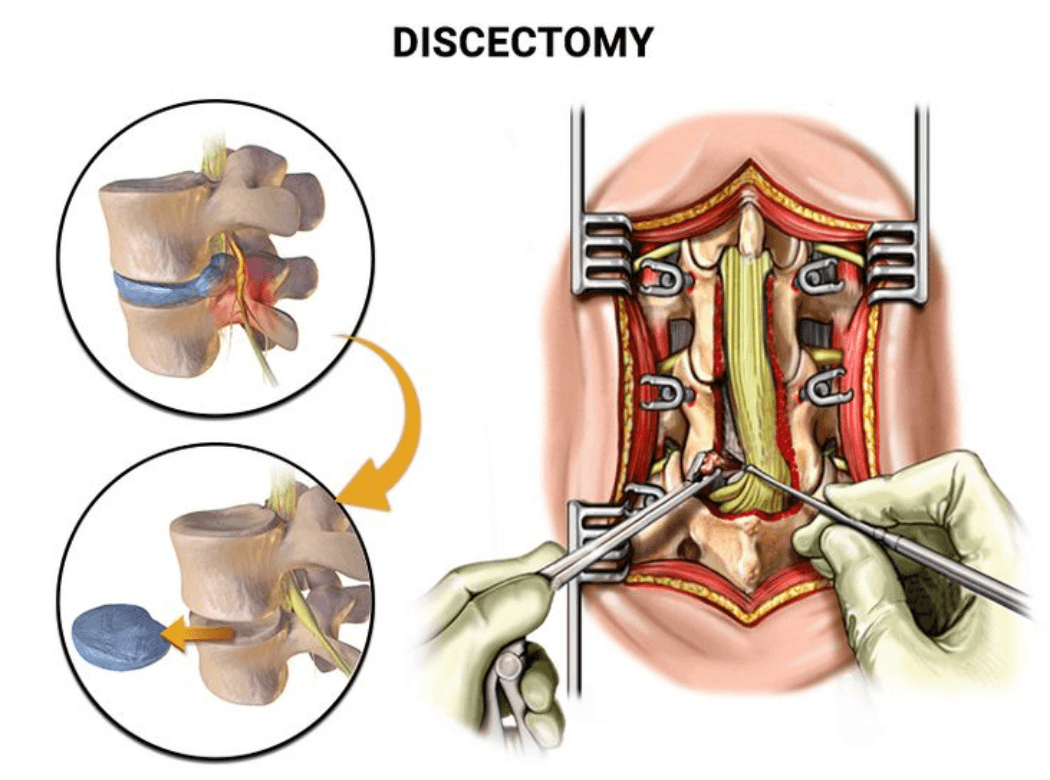 Illustration of a vertebroplasty procedure on a vertebral compression fracture
