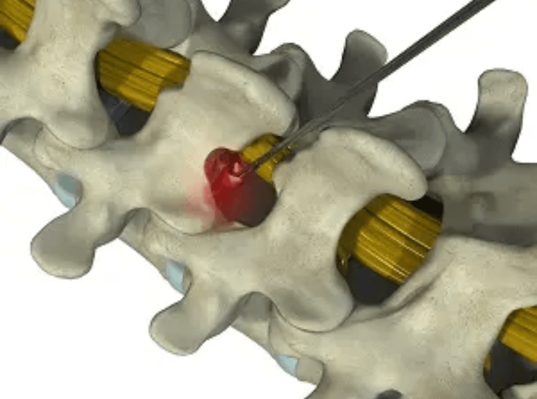 Surgical team performing a vertebroplasty procedure