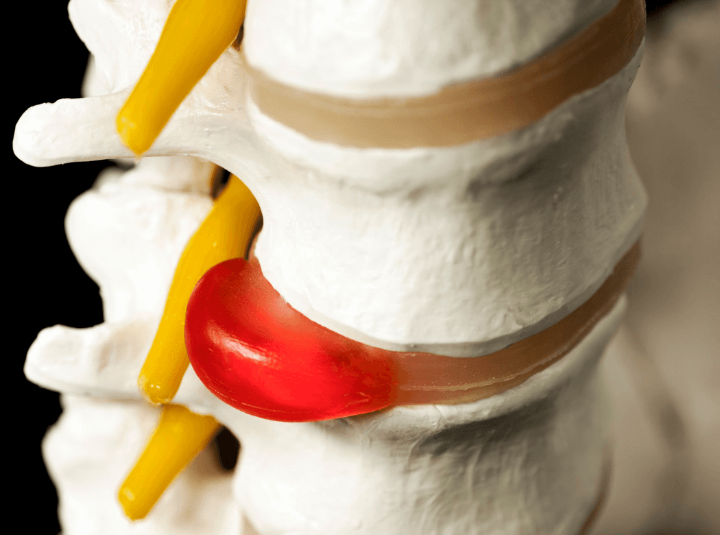 Illustration of the lumbar spine and spinal canal