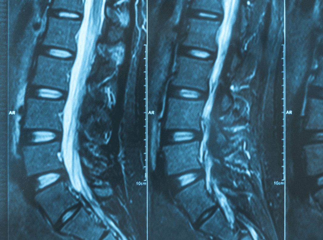 Spine anatomy illustration overlaid on a patient's back