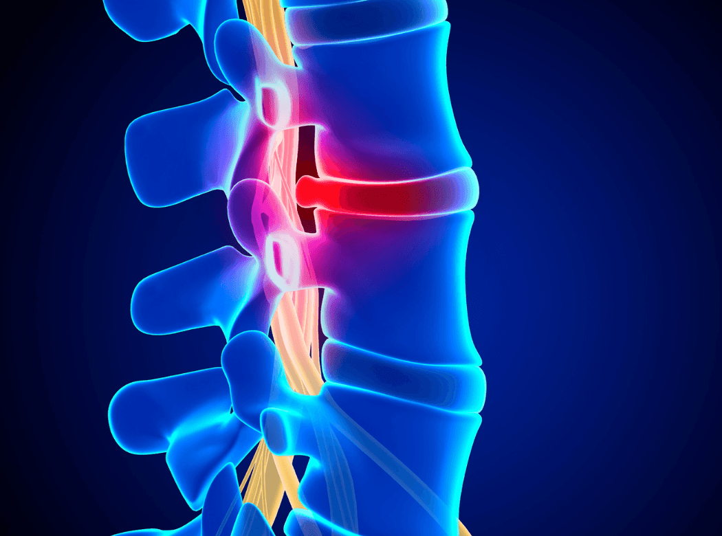 Surgical team performing a spinal fusion procedure