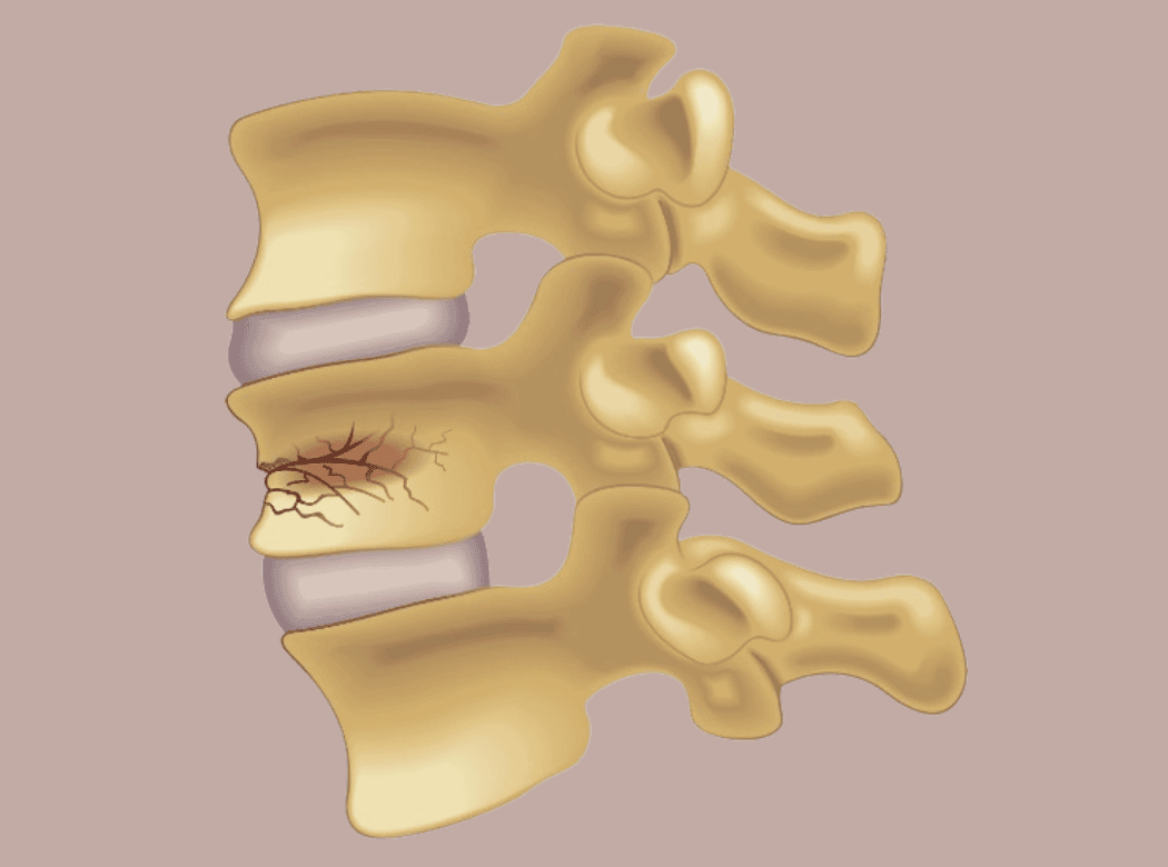 Surgical team performing a vertebroplasty procedure