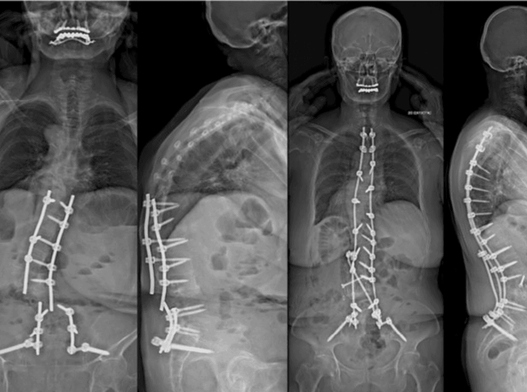 Surgical team performing a vertebroplasty procedure