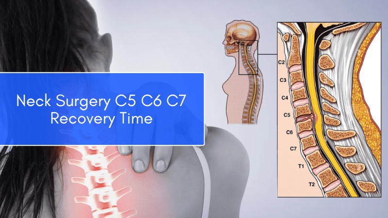 Neck surgery C5 C6 C7 recovery time